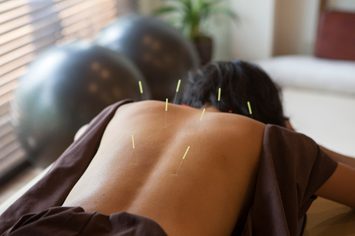 Trigger points acupuncture release