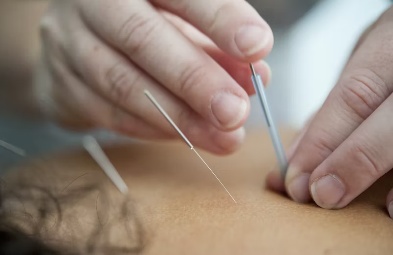 Acupuncture, Chinese Medicine