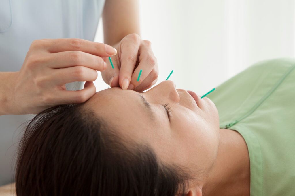 Acupuncturist gently inserting fine needles into a female patient's face during a facial acupuncture session at GS Clinic.