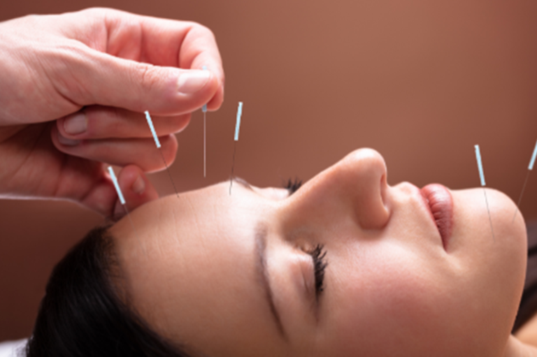 Facial Rejuvenation Acupuncture