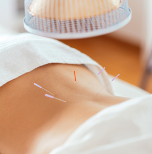 acupuncture on low back