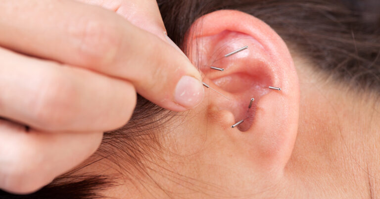 auricular treatment-gs acupuncture clinic