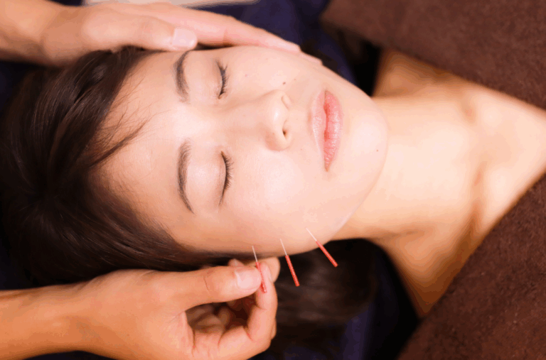 Facial Acupuncture​