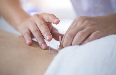 acupuncture-in-vaughan